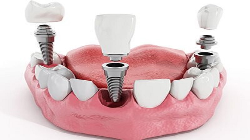 4- قرار دادن ایمپلنت های دندانی