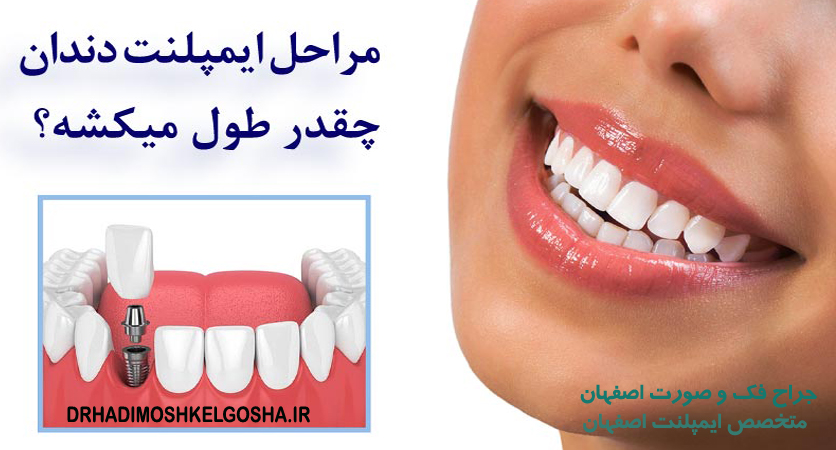 ایمپلنت های دندان اصفهان