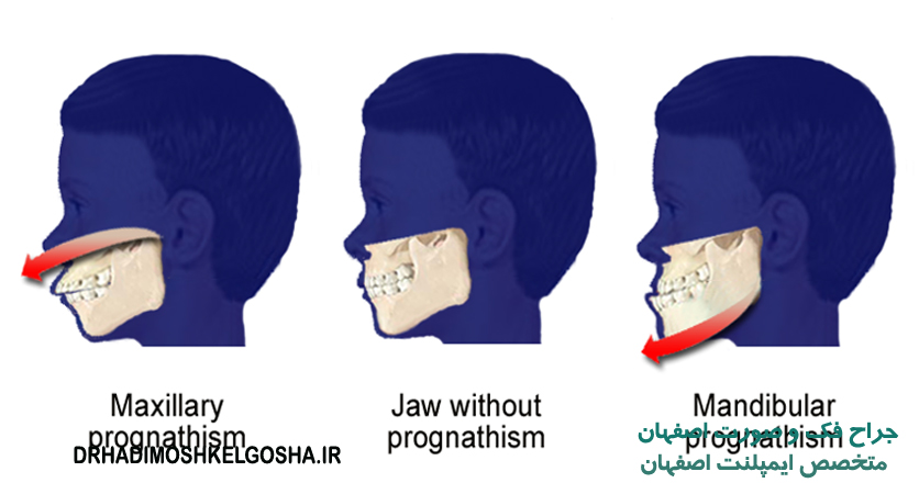 جراحی فک و صورت در اصفهان