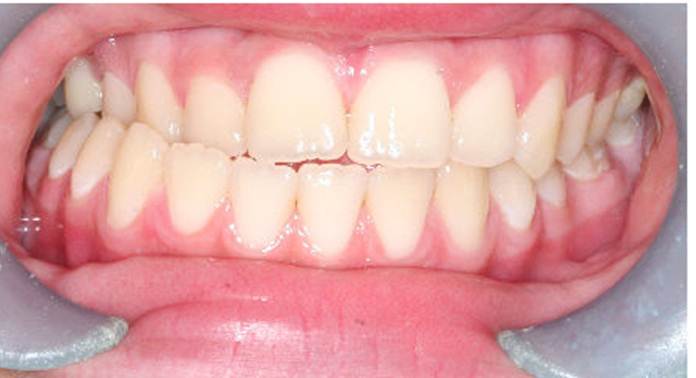 درمان دندان های اوربایت
