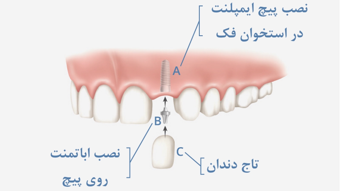 کاشت دندان در اصفهان