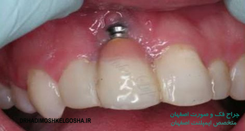 درمان شکست ایمپلنت دندان