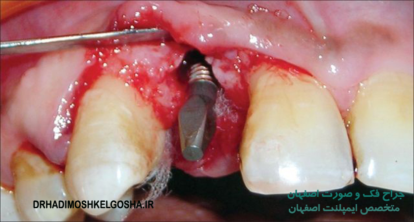 درمان شکست ایمپلنت دندان