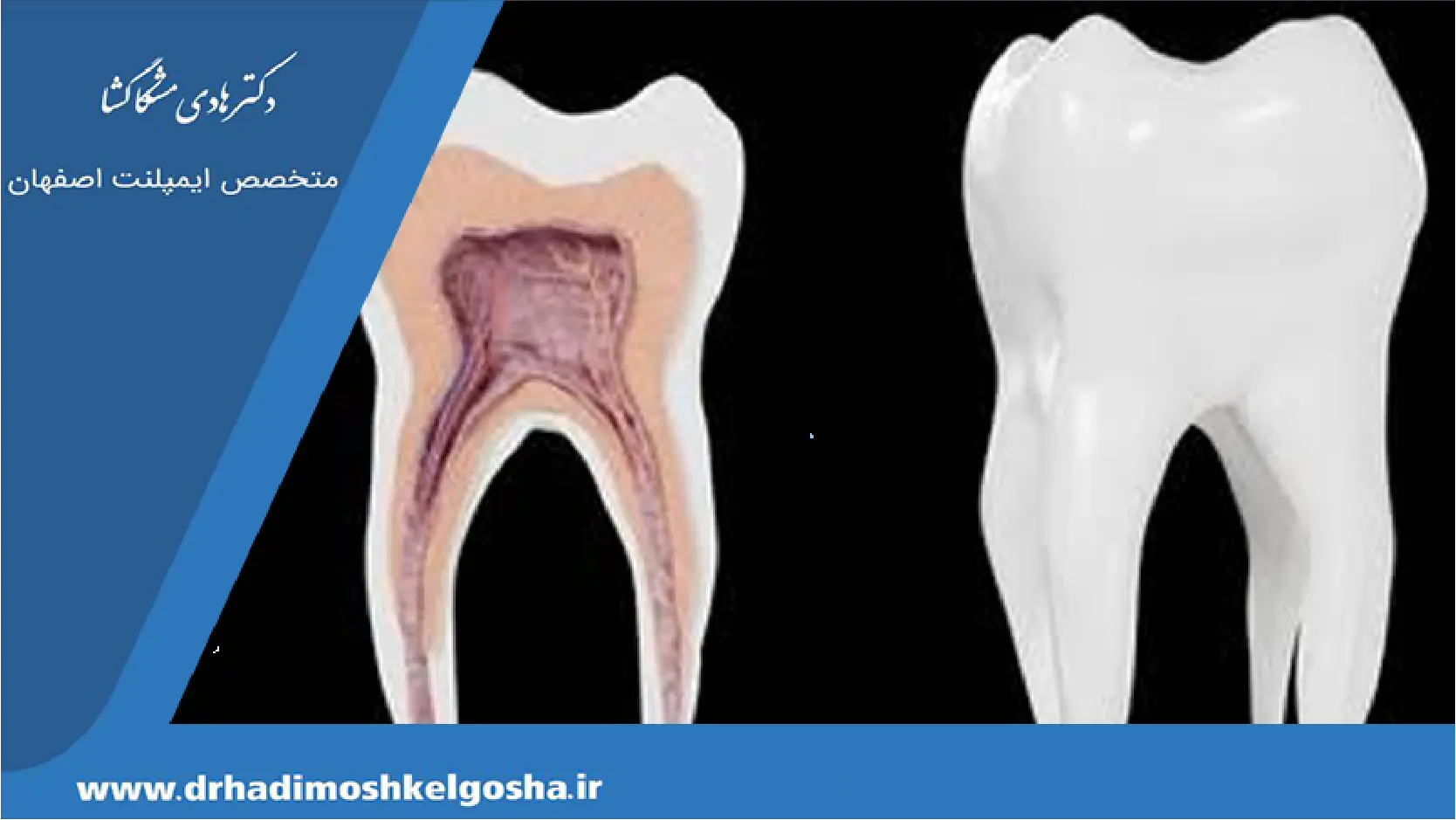 ضرر احتمالی پر کردن دندان
