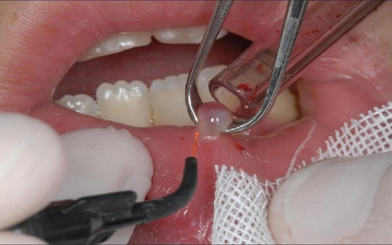 جراح دهان، فک و صورت اصفهان جراحی های داخل دهانی