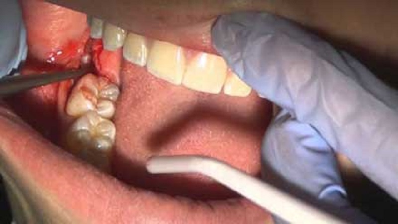 جراح دهان، فک و صورت اصفهان مراقبت های پس از جراحی دهان