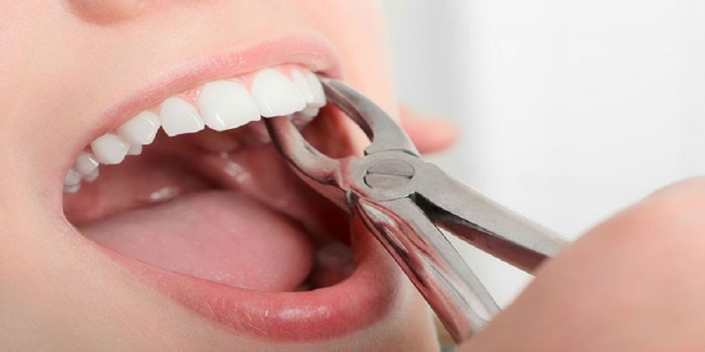 جراح دهان، فک و صورت اصفهان کشیدن دندان