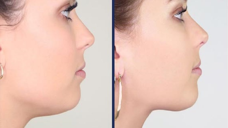 جراح فک و صورت اصفهان درمان با جراحی فک و صورت