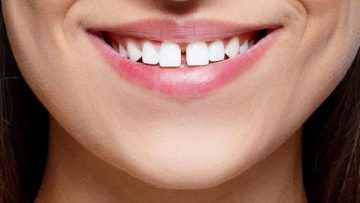 وجود فاصله در بین دندانها