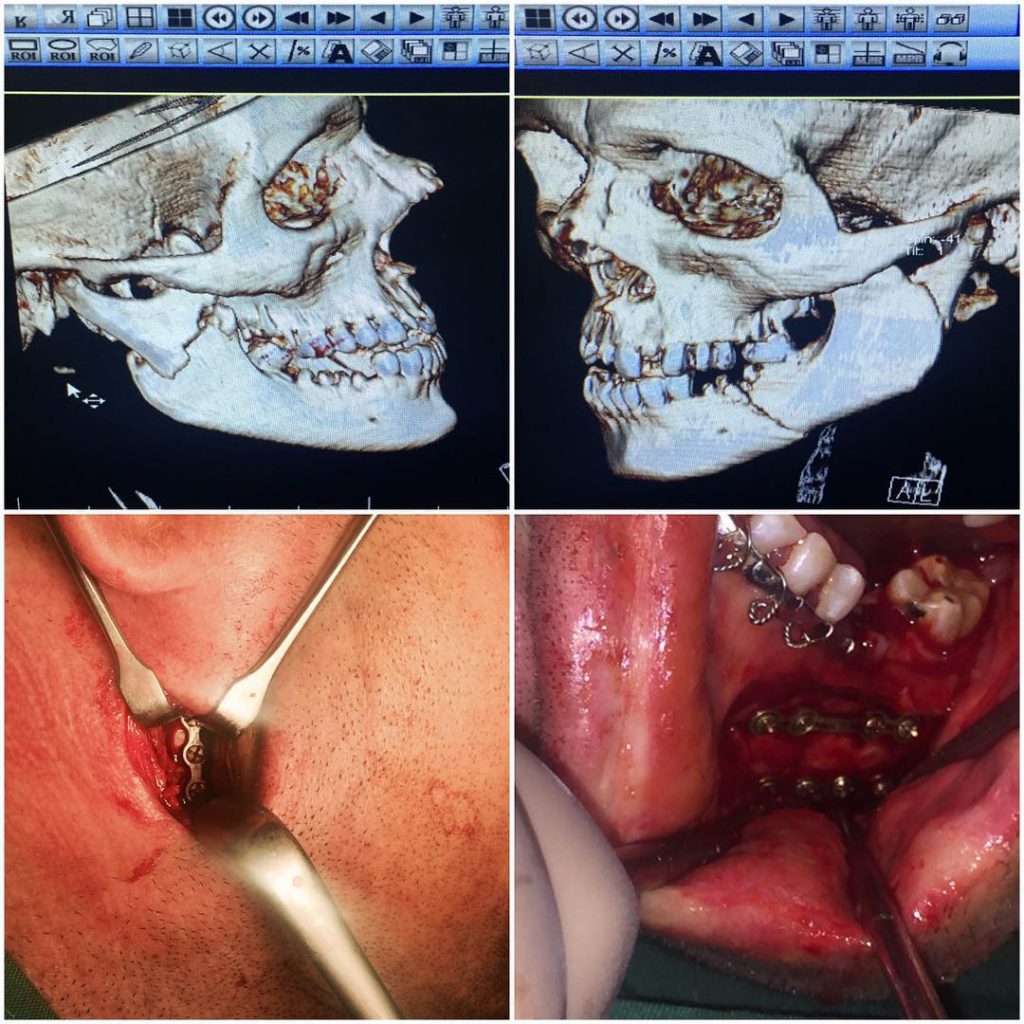 Sub condylar ramus & body fx fixation via Retromandibular & intra oral aproach with dear prof. Dr Keyhan