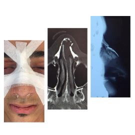 Lateral Nasal and Septum Fx with deviation