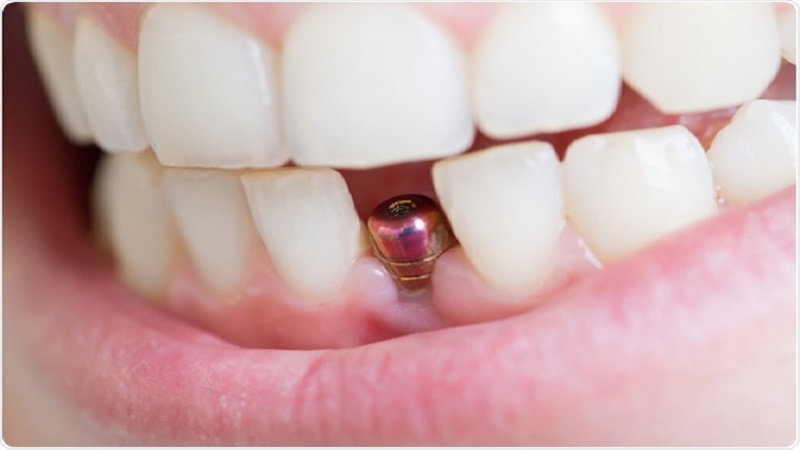 تعویض ایمپلنت دندان