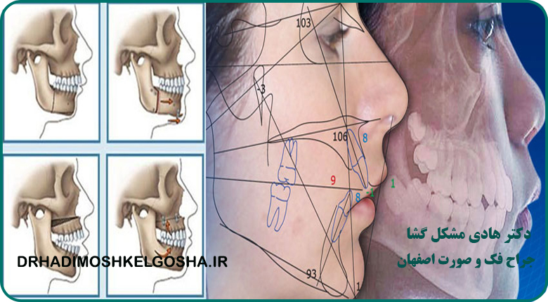 جراحی دو فک در اصفهان