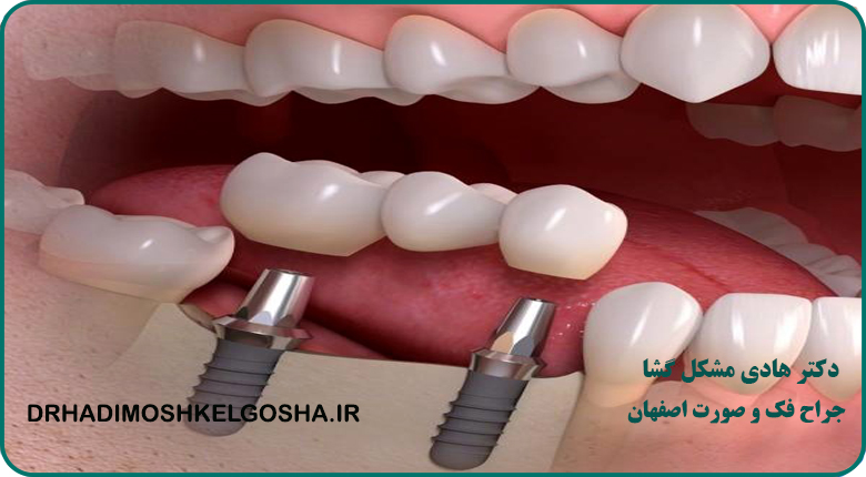 ایمپلنت دندان در اصفهان