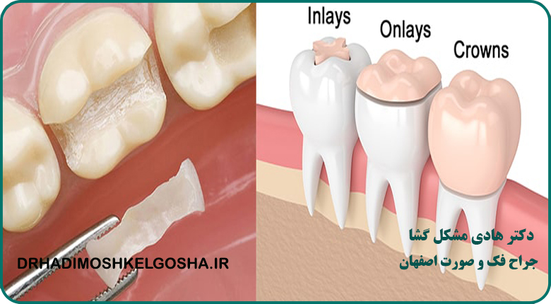 ترمیم دندان ها در اصفهان
