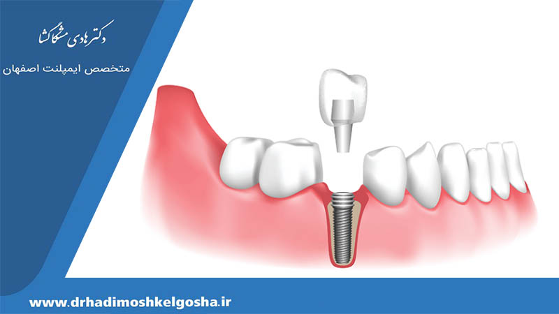 کاشت مجدد ایمپلنت دندان