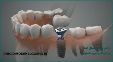 درمان با ایمپلنت های دندانی
