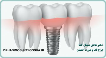 هزینه ایمپلنت دندان در اصفهان