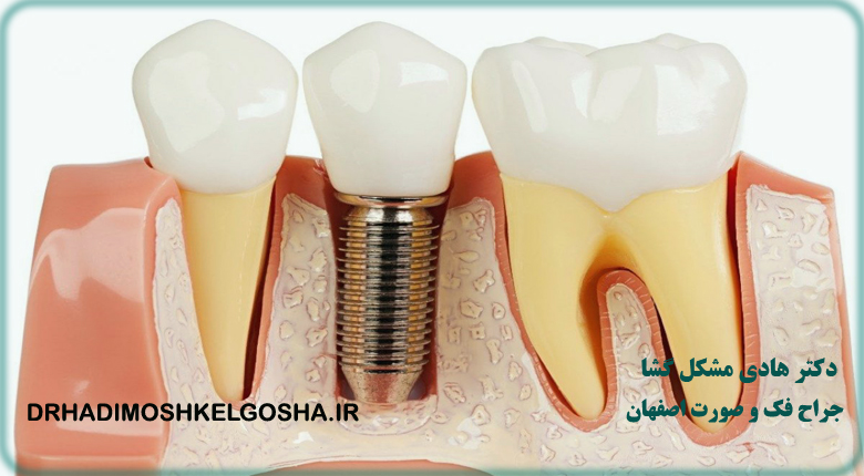 ایمپلنت دندان در اصفهان
