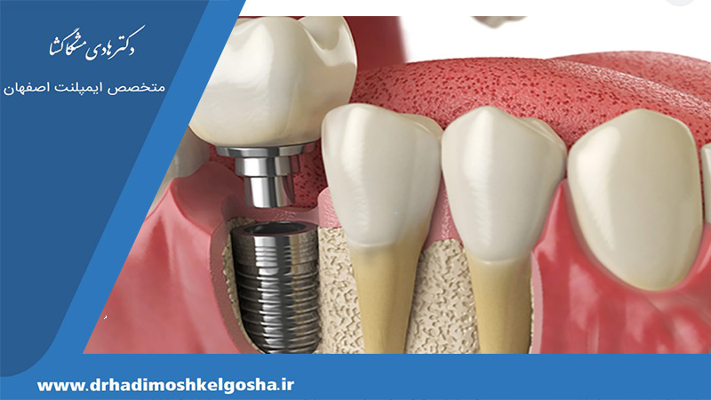 اثرات مثبت ایمپلنت برای دندان