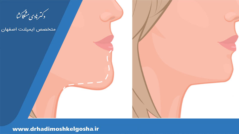 جلو بودن فک پایین
