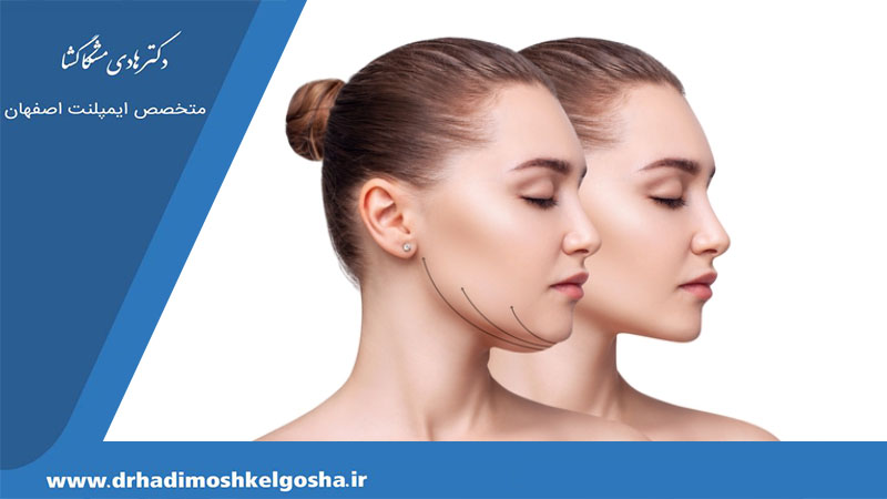 جراحی زیبایی فک برای متقارن سازی چهره