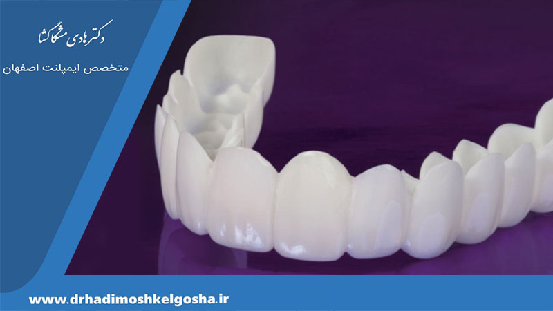 استفاده از لمینت متحرک دندان