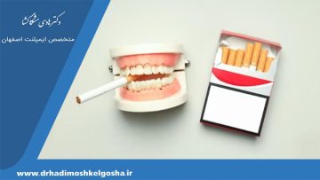 مصرف دخانیات بعد از ایمپلنت
