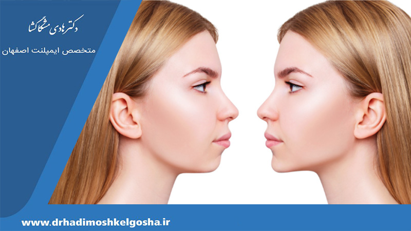 تاثیر جراحی فک و صورت در تغییر چهره