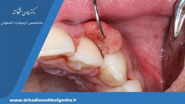 جراحی ضایعات پاتولوژیک دهان