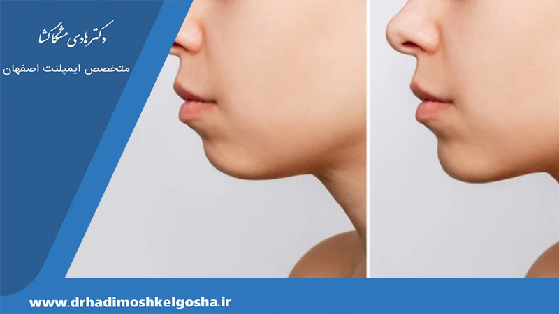 اصلاح چانه کوچک با جراحی