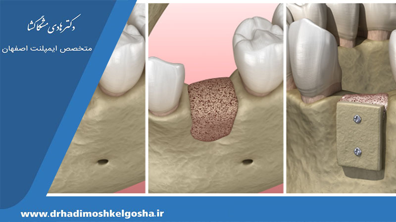 بازسازی استخوان فک با پیوند استخوان