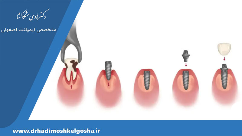 مراحل کامل ایمپلنت دندان