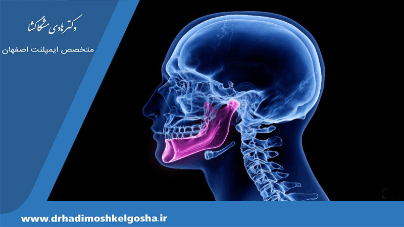 استئومیلیت فک