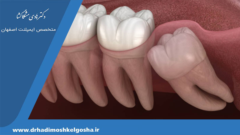 علل نهفتگی دندان عقل