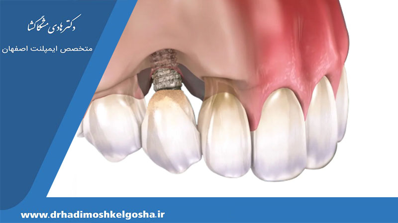 علائم عفونت ایمپلنت دندان