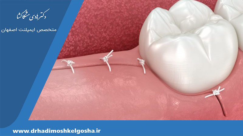 ترمیم لثه پس از جراحی دندان عقل