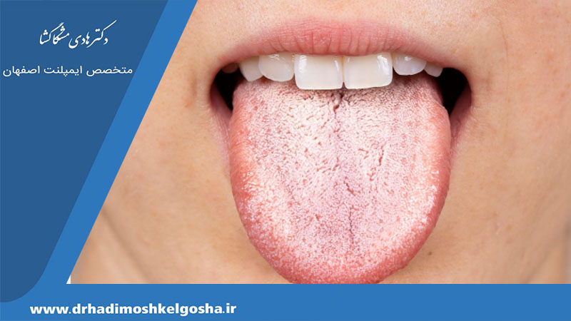 قارچ های دهانی