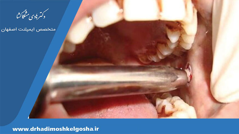 بیوپسی ضایعات دهانی