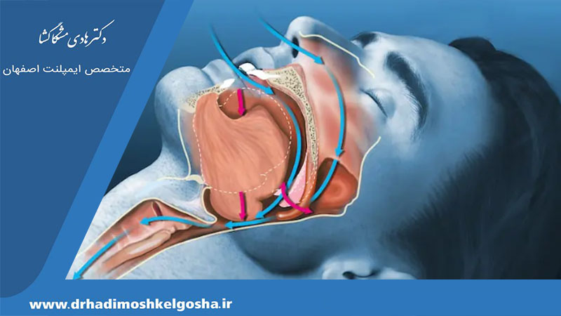 جراحی فک برای درمان آپنه خواب
