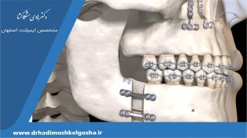اصلاح جلو بودن فک