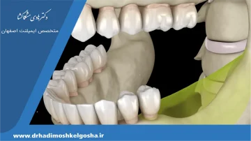 تحلیل رفتن استخوان فک