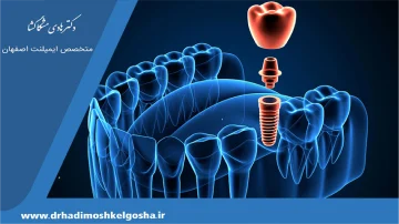 تفاوت ایمپلنت دیجیتال و معمولی