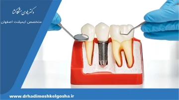 پیوند استخوان برای ایمپلنت