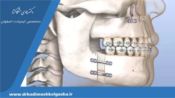 جراحی فک‌و اصلاح بایت