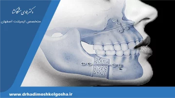 نیاز من به جراحی‌فک