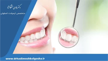 تعداد جلسات برای کامپوزیت