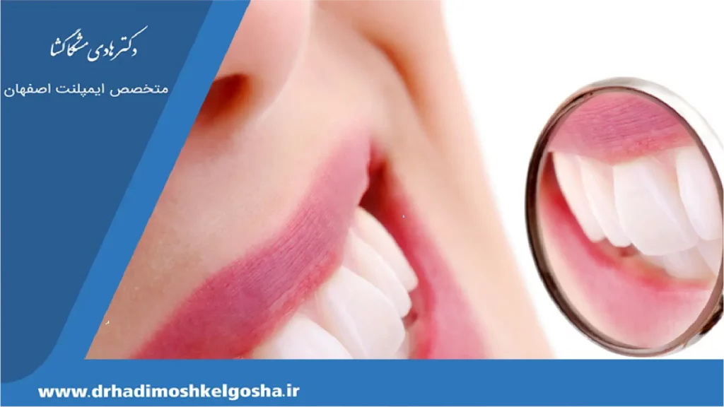 لمینت سرامیکی