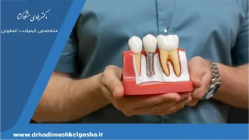 دندان عقل نهفته